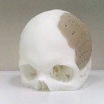 Technologia 3D w produkcji polimerowych implantów